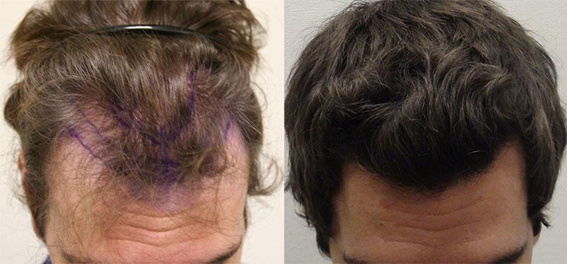 Hair Transplant Surgery – What Options Do You Have?