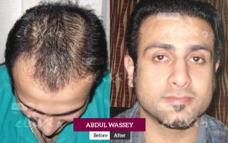 Hair Transplant in Islamabad