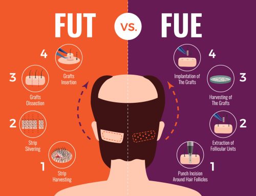 FUE vs. FUT Hair Transplant in Pakistan: Which is Right for You?