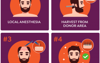 Elixir Hair Transplant Steps