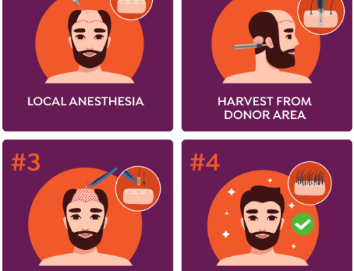 Five Important Facts About Hair Transplants