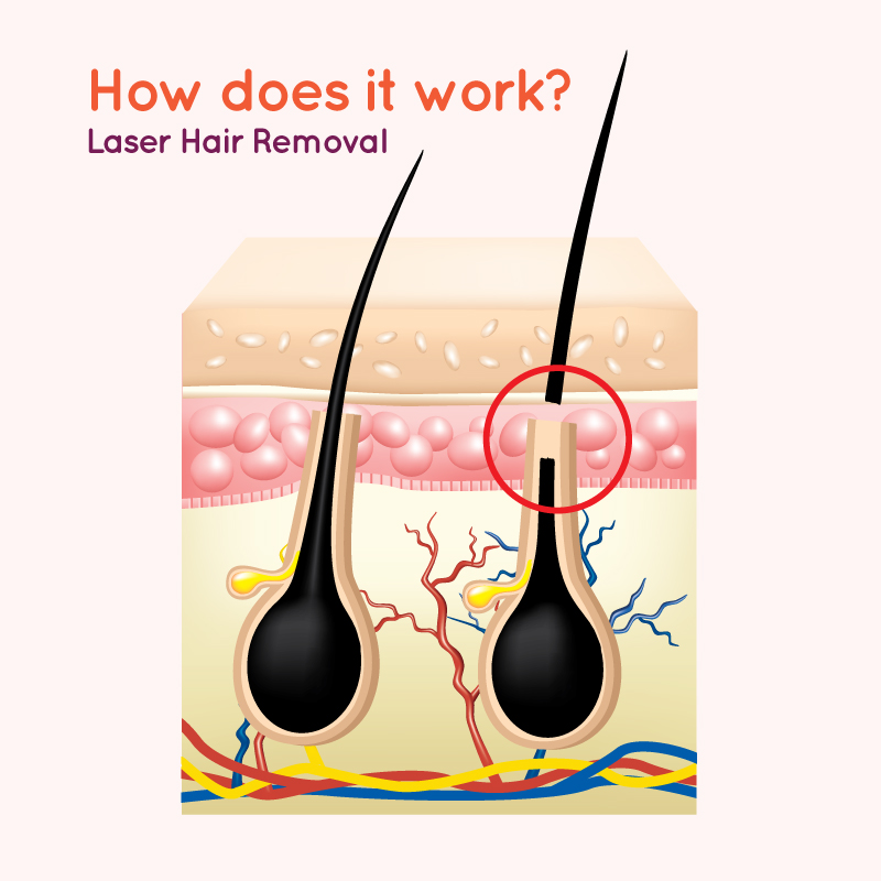 Laser Hair Removal Process at Elixir Islamabad