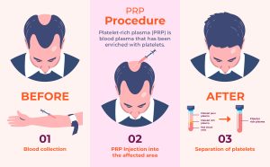 PRP treatment in Islamabad