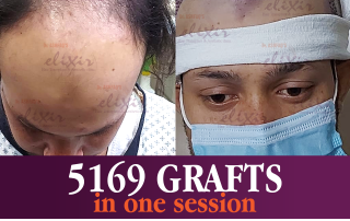 Elixir Hair Transplant Islamabad