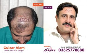crown hair transplant Islamabad
