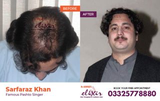 hair transplant in Islamabad