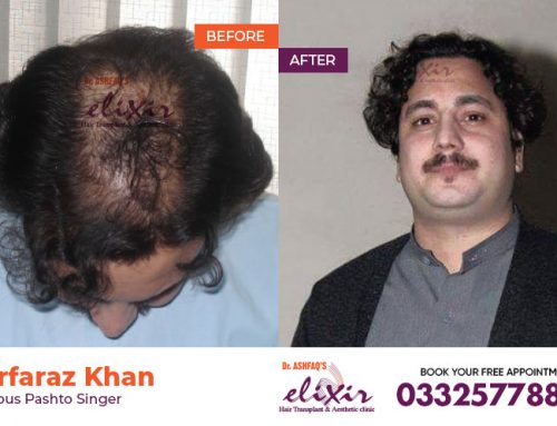 How to Evaluate Hair Transplant Results?
