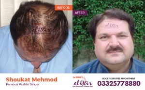 natural hair restoration Islamabad