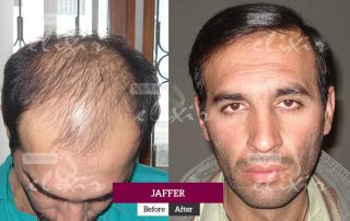 FUE hair transplant in Islamabad