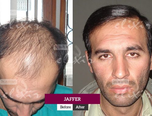 Is it Worth Getting an FUE Hair Transplant?