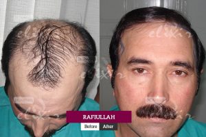 FUE hair transplant in Pakistan