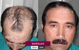 FUE hair transplant in Pakistan