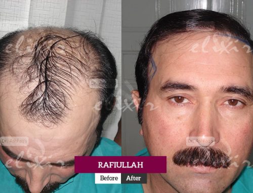 Why You Should Go For FUE Hair Transplant?
