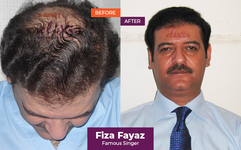 FUE Hair Transplant in Islamabad | Best Hair Transplant in Pakistan