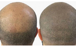 Scalp Micropigmentation (SMP)