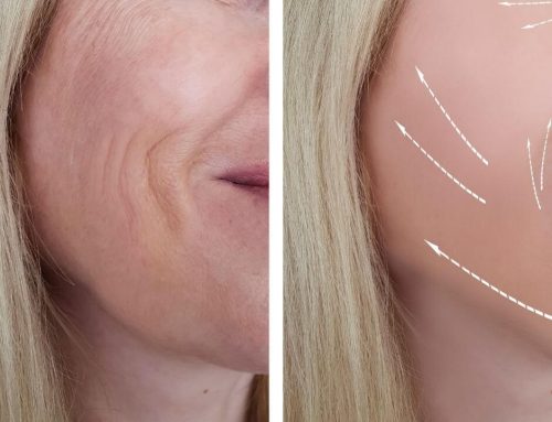 All You Need To Know About Cheek Augmentation Filler