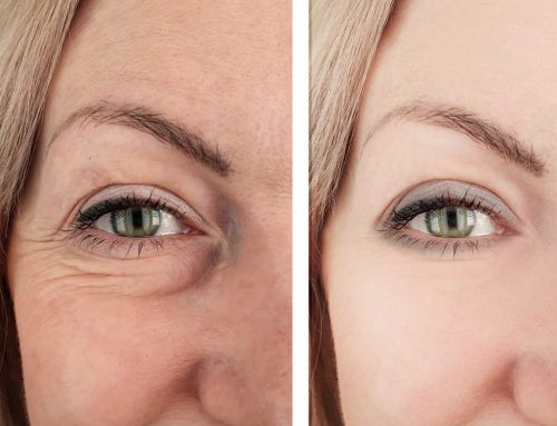 Fillers for Dark Circles: Everything You’ve Ever Wanted to Know