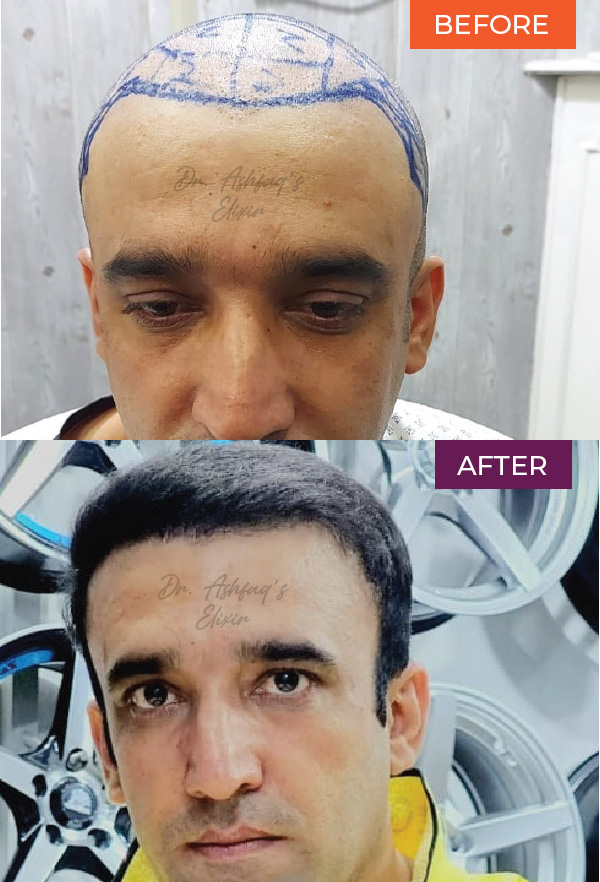 Crown hair transplant Islamabad