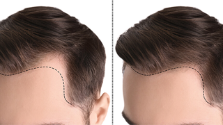 natural hair line creation