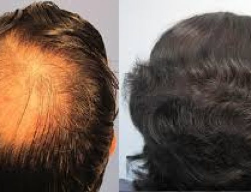 Do Hair Transplant Surgery Works On The Crown?