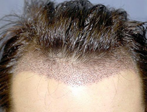 What is DHI Hair Treatment and Its Advantages?
