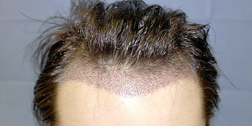 What is DHI Hair Treatment and Its Advantages?