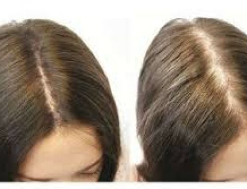 Facts About Female Hair Transplant in Pakistan