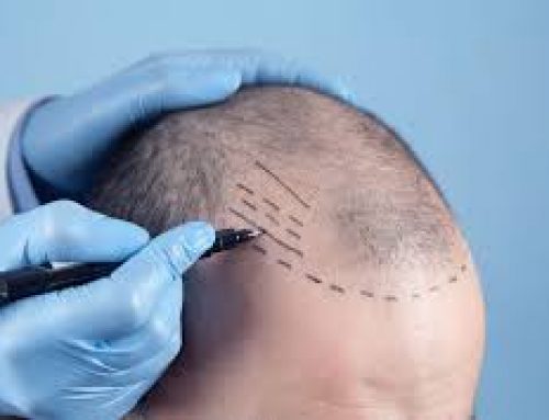 Why To Prepare For FUE Hair Transplant?