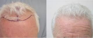 grey hair transplant