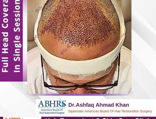 Care After Hair Transplant During Winter Season