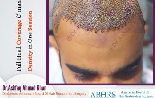 hair transplant Islamabad