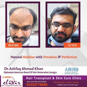 hair transplant in Islamabad