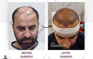 hair transplant surgery in Islamabad