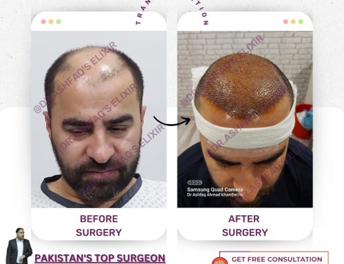 Safe and Effective Hair Transplant Surgery