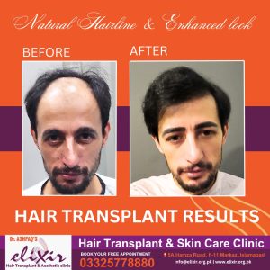 hair transplant Islamabad