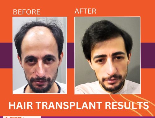 Why The Quality of Donor Area is Important in Hair Transplant?