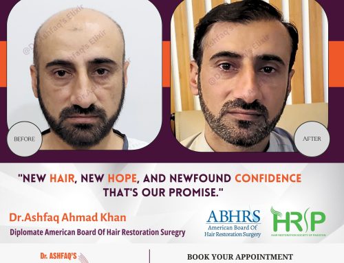 Hair Transplant Tips for Prolonging Results