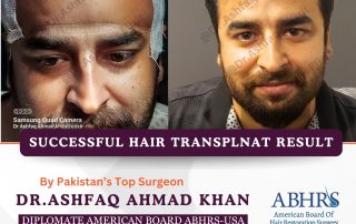 hair transplant results