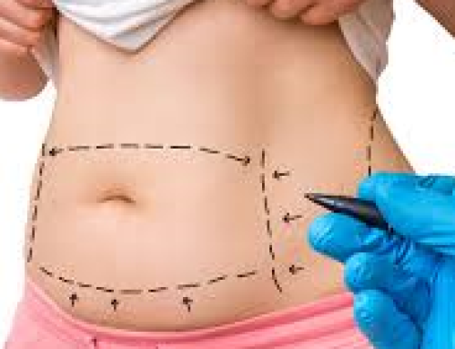 Important Facts About Tummy Tuck You Should Know?