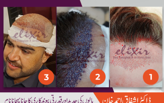 Hair transplant in Islamabad
