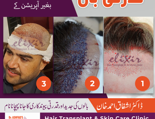 Important Questions to Ask Before a Hair Transplant