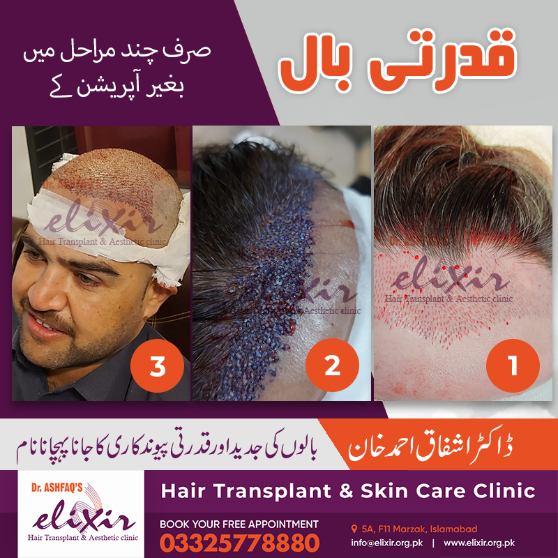 Hair transplant in Islamabad